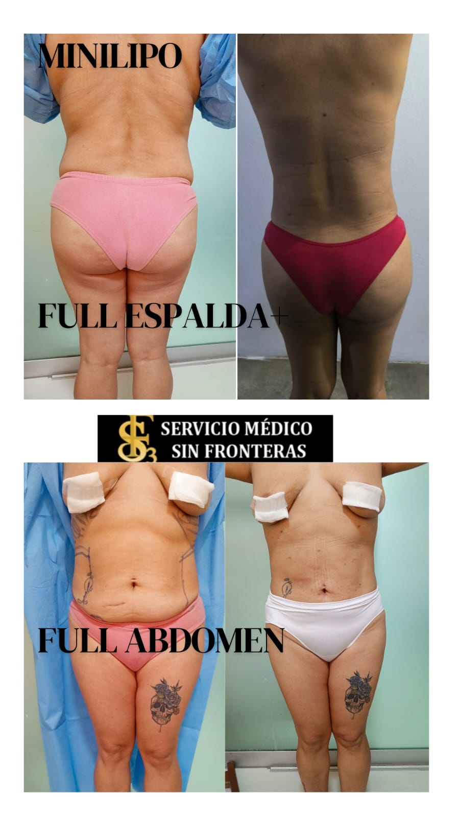 Resultado Lipo 360 5